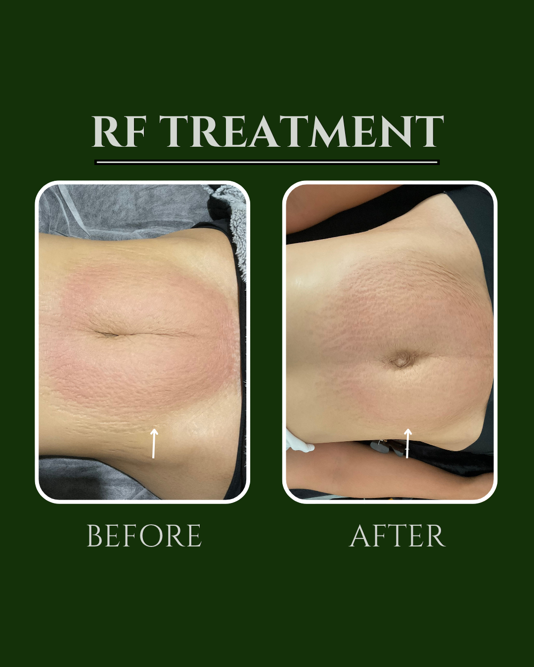 RF treatment before and after on a client's stomach