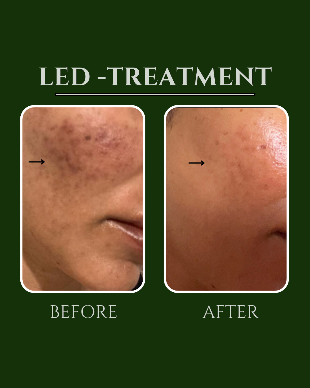 LED treatment before and after showing reduced pigmentation on a cheek