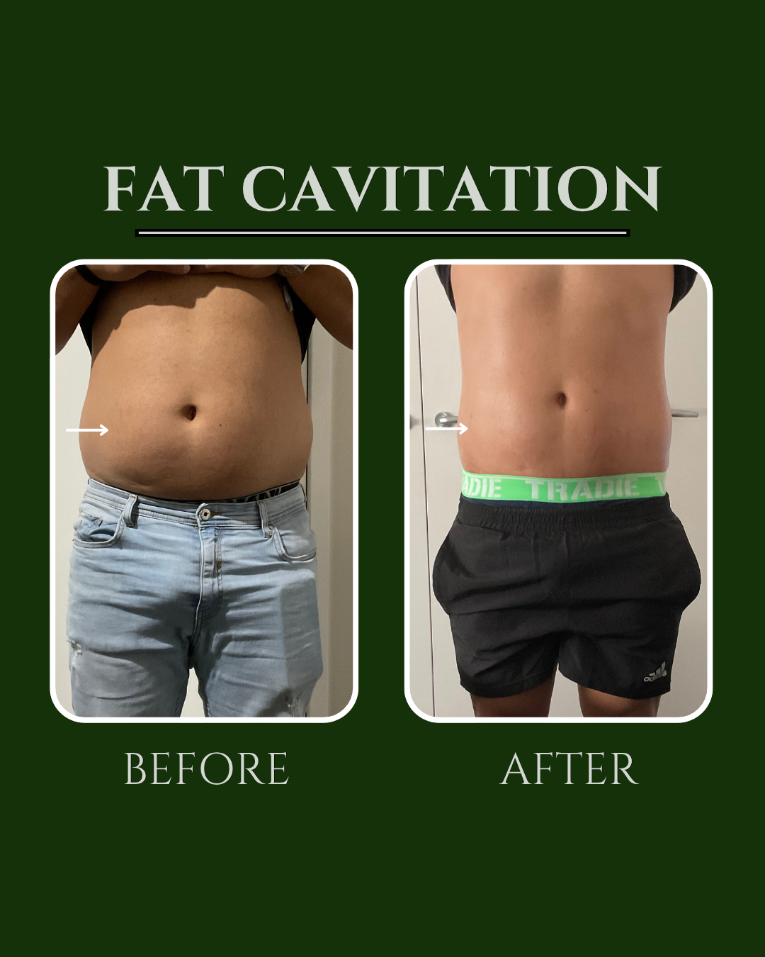 Fat cavitation before and after on a client's stomach